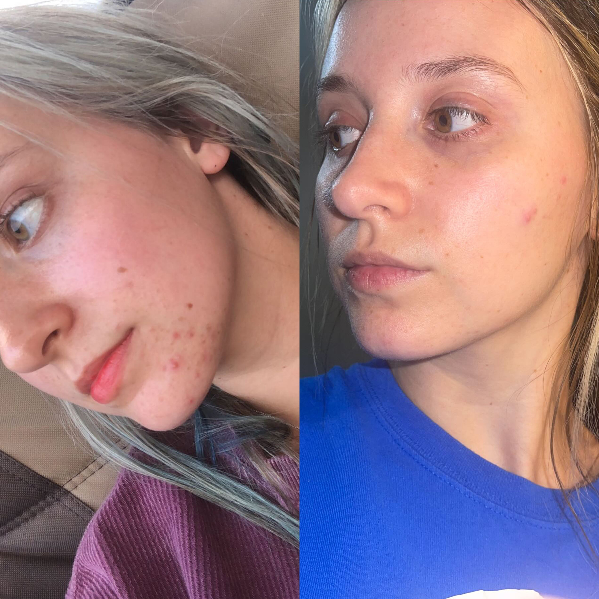 Hemp seed oil before and after image of a young woman with cystic acne on her chin showing less acne and clear skin