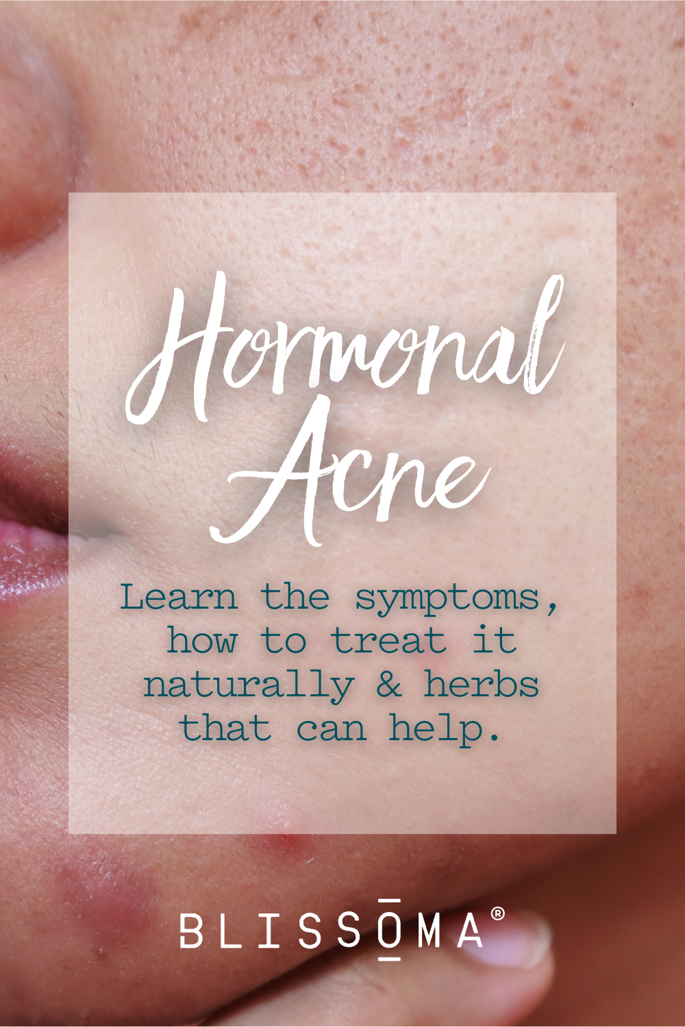 How To Treat Hormonal Acne Naturally Learn Hormonal Acne Symptoms And