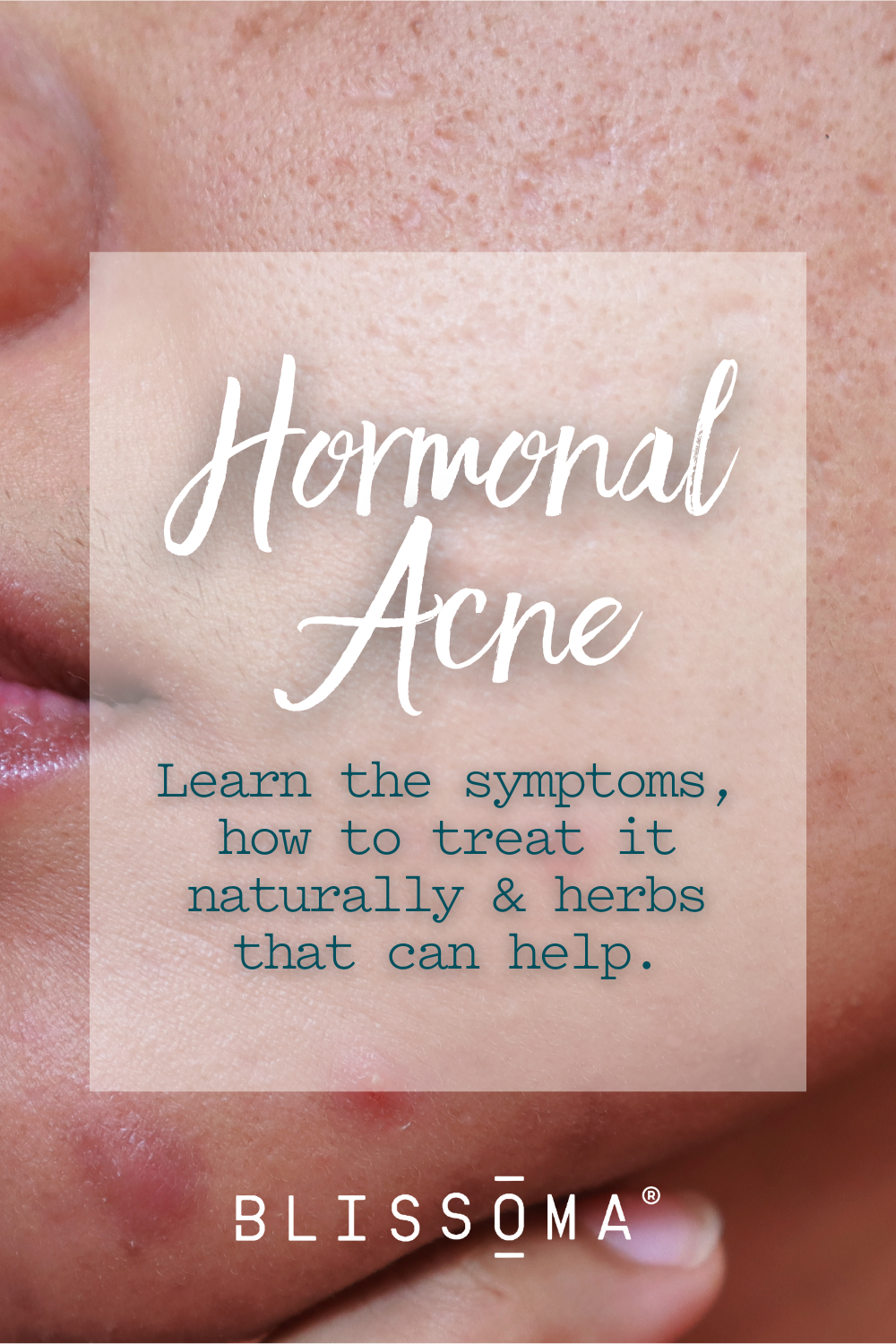 Hormonal acne natural deals treatment