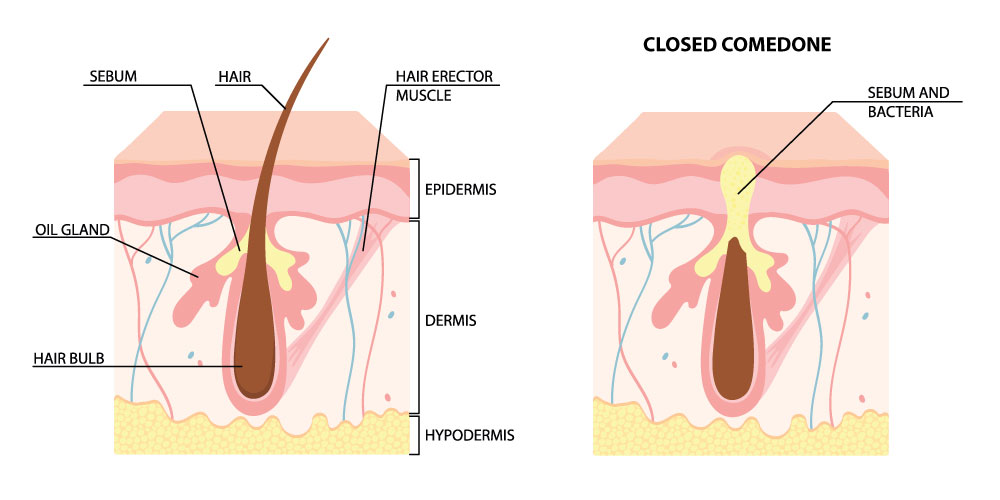 Comedogenic cosmetic ingredients rankings are wrong. How comedogenicity is more complicated than you think and why acnegenicity is even more important for acne breakouts