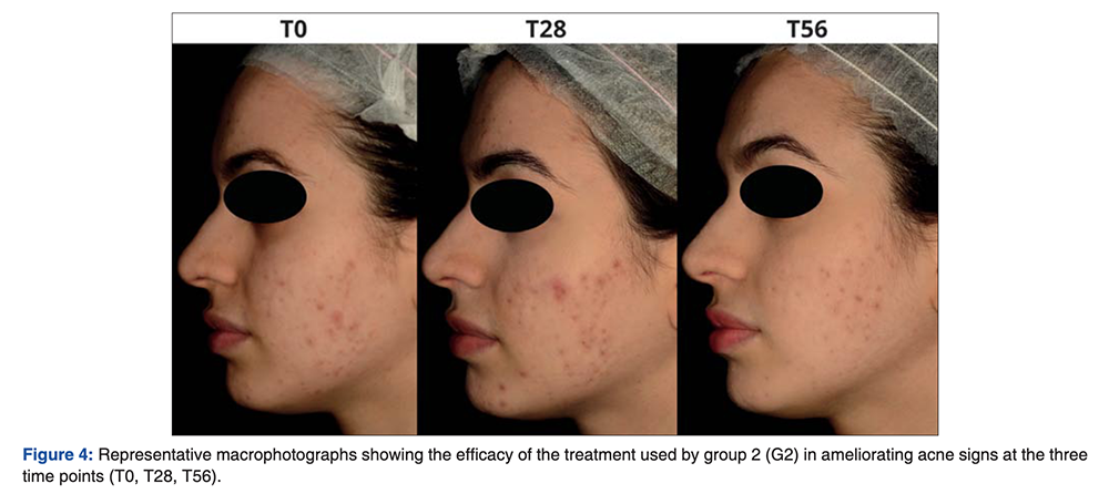 Ectoin has been studied for its benefits for acne and offers skin hydration and reduction of comedones when used over several months in skincare products at 1% concentration.