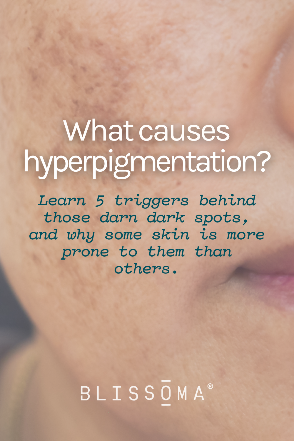 What is hyperpigmentation - the causes of dark spots on your face and body and the benefits of melanin 