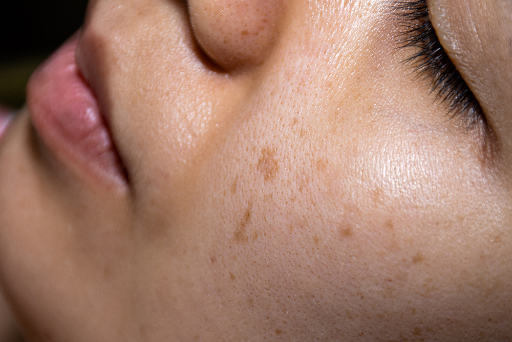 Why do I have hyperpigmentation? Reasons dark spots form on skin can include sun damage