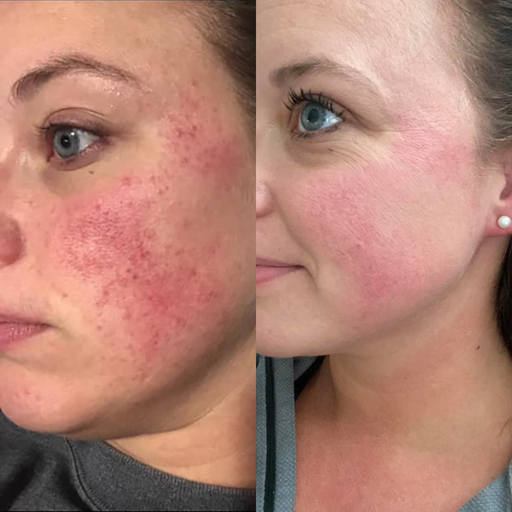 Do I have rosacea or just red cheeks? Natural skincare results after 6 weeks of using Blissoma from holistic esthetician Karmin Keller
