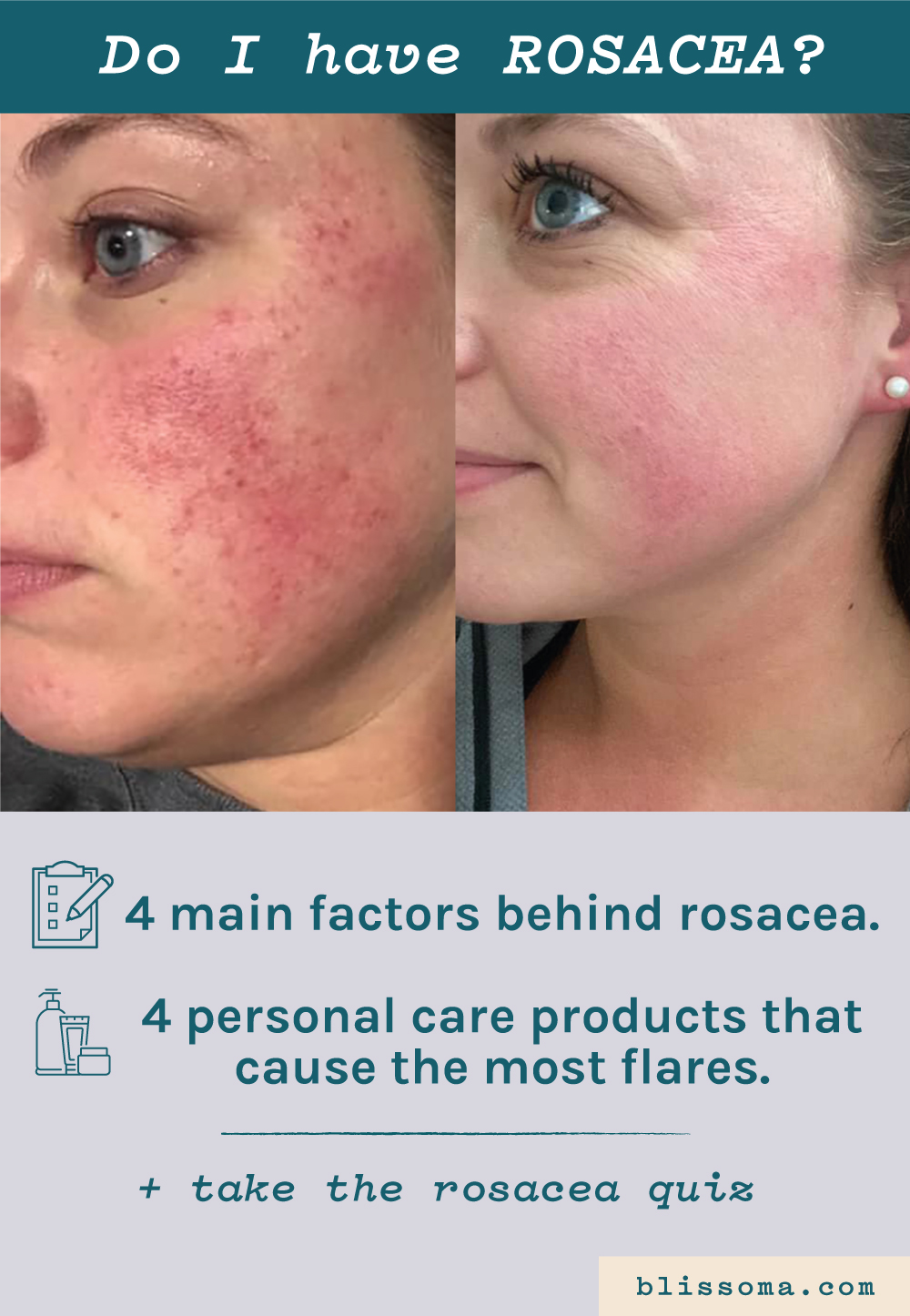 Do I have rosacea quiz - how your microbiome may be to blame plus the 4 main causes of rosacea and personal care products that can cause flares