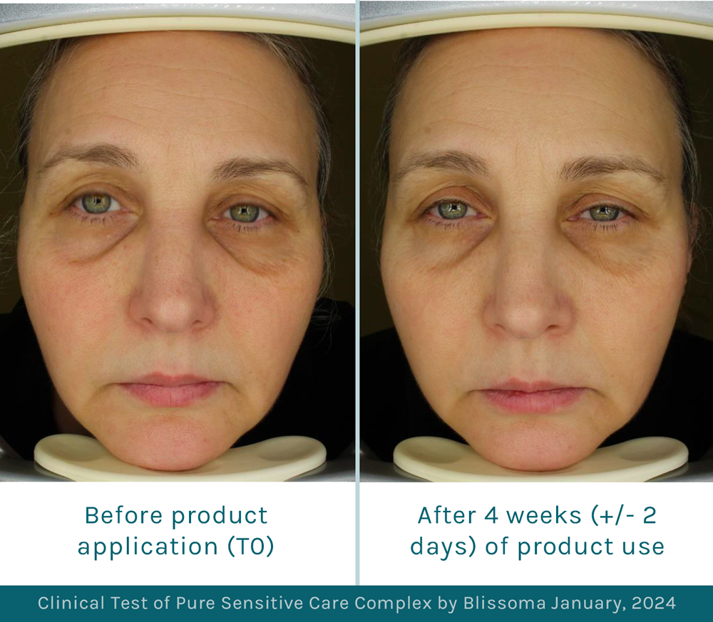 Before and after image of Blissoma's natural redness reduction cream clinical test results on mature skin of a 49 year old woman after 28 days of using an organic moisturizer and sensitive skin cleanser daily