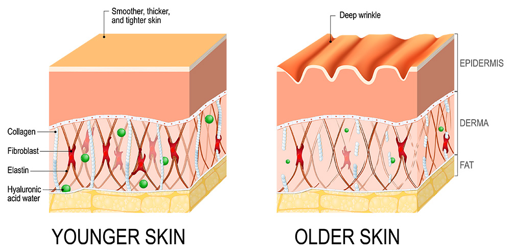 Collagen structure diagram in young and old skin showing collagen damage