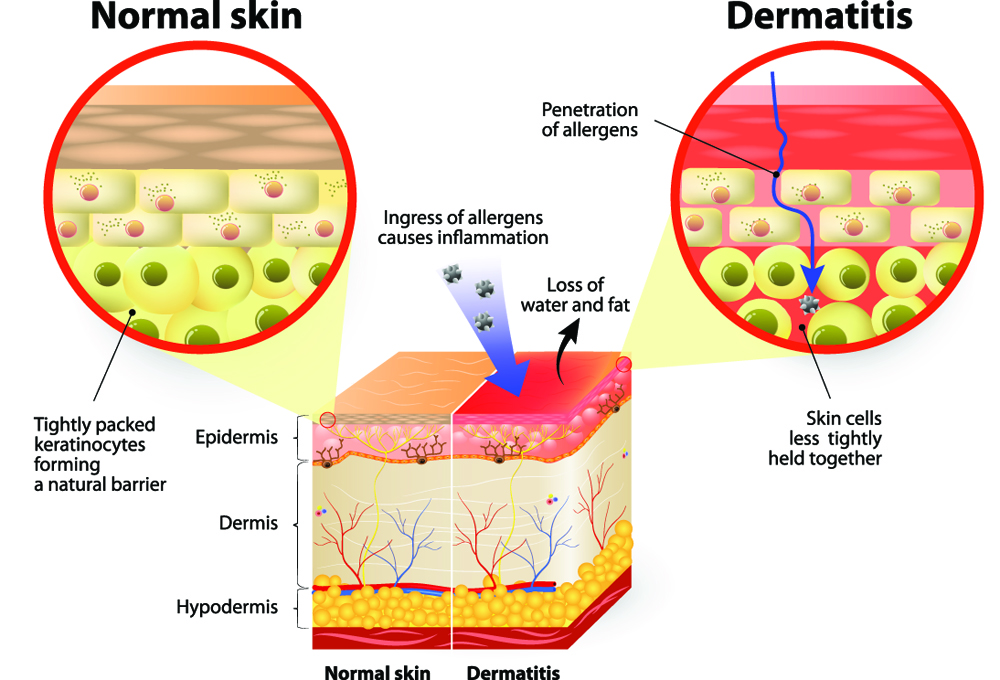 When you wash your face with the wrong facial cleanser it causes skin irritation and inflammation that can cause acne, eczema, dryness and other skin problems. This is why skin care is important to having healthy skin.